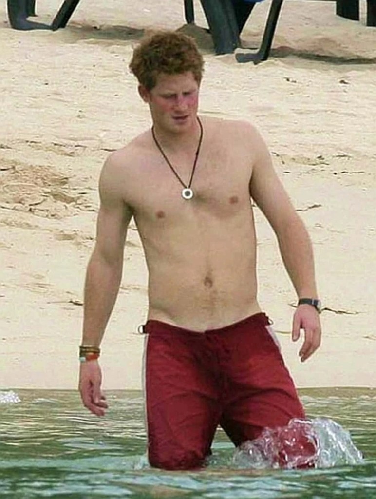 Prince Harry chest deformity